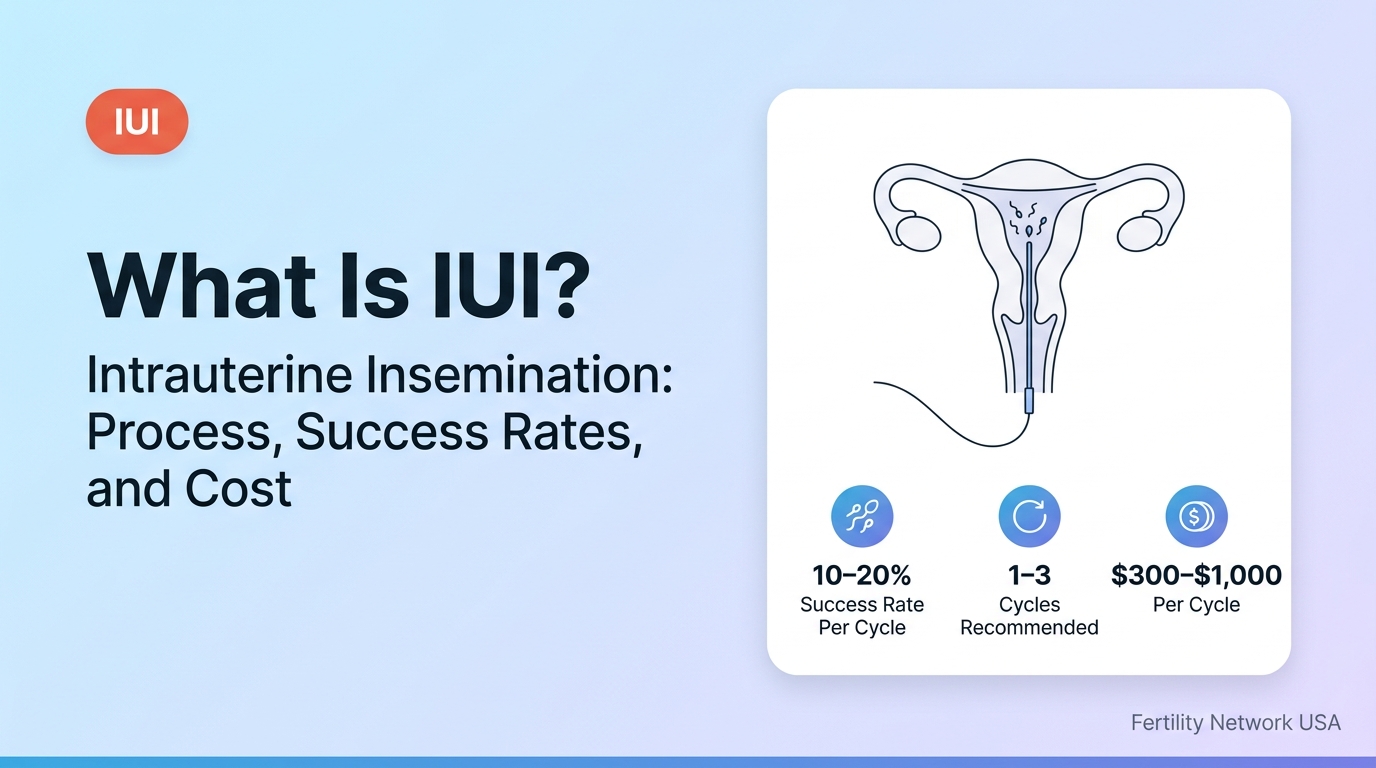 Medical illustration of IUI (intrauterine insemination) — catheter delivering washed sperm directly into the uterus at ovulation. Success rate 10–20% per cycle for women under 40.